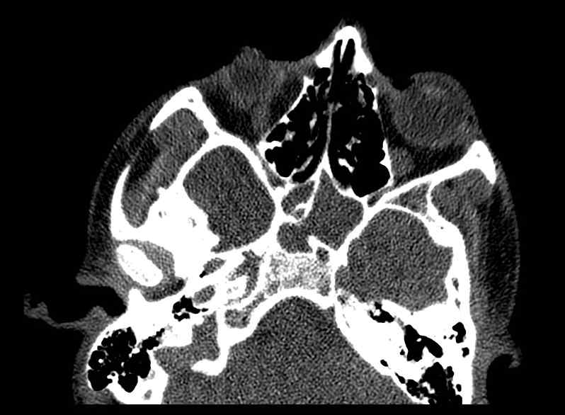Arachnoid cyst- extremely large (Radiopaedia 68741-78450 Axial bone window 9).jpg