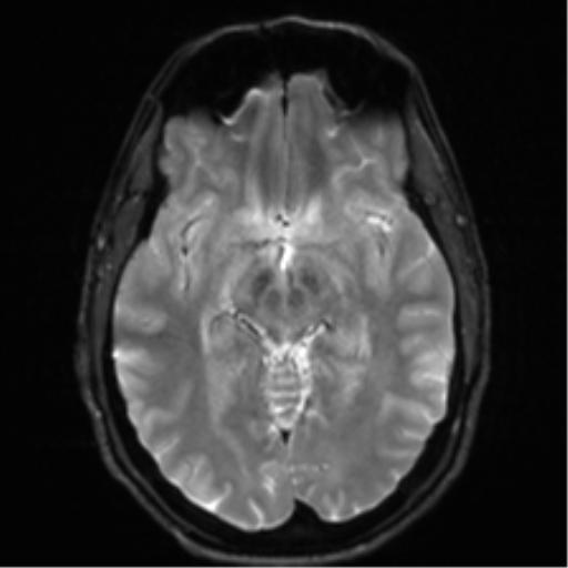 Arachnoid cyst - cerebellopontine angle (Radiopaedia 59689-67083 Axial DWI 16).png