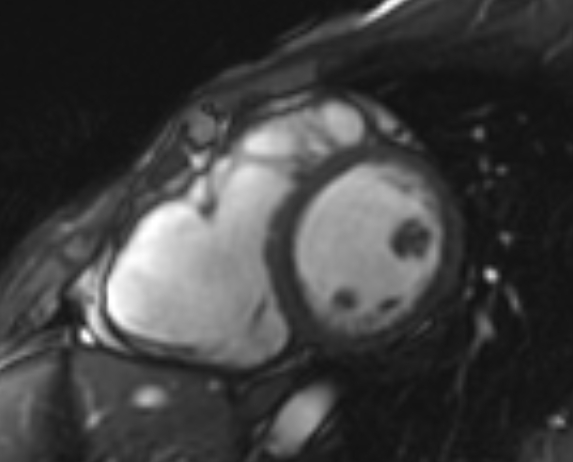 Arrhythmogenic right ventricular cardiomyopathy (Radiopaedia 69564-79464 short axis cine 160).jpg