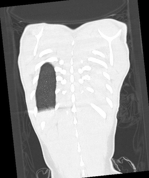 Arrow injury to the chest (Radiopaedia 85367-100975 Coronal lung window 114).jpg