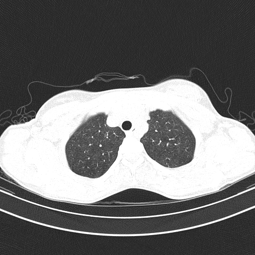 File:Arteria lusoria (Radiopaedia 88528-105192 Axial lung window 16).jpg
