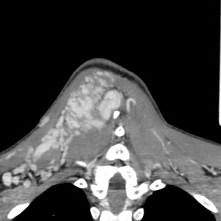 Arteriovenous malformation of the neck (Radiopaedia 53935-60062 D 47).jpg