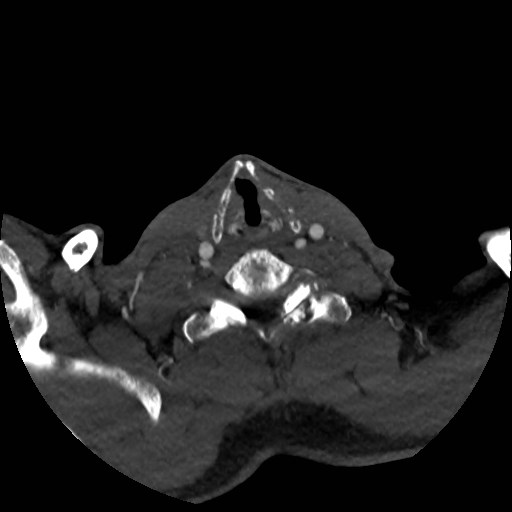File:Artery of Percheron infarct (Radiopaedia 48088-52894 A 45).jpg