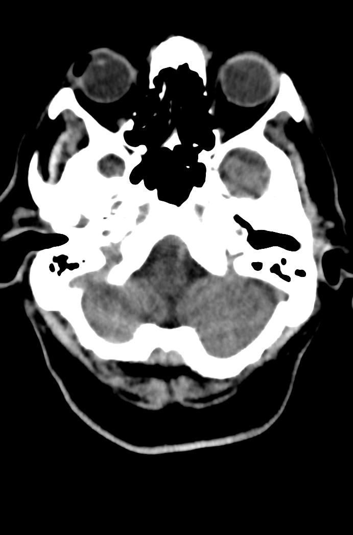 Artery of Percheron infarction (Radiopaedia 80613-94202 Axial non-contrast 40).jpg