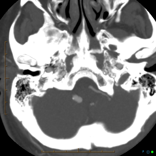 File:Artifactual basilar artery stenosis due to metallic stent (Radiopaedia 31206-31923 A 7).jpg