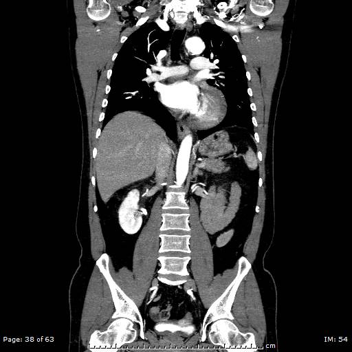 Ascending aortic aneurysm (Radiopaedia 50086-55404 B 38).jpg