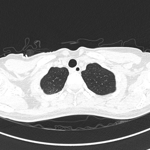 Aspergilloma (Radiopaedia 26223-26347 Axial lung window 8).jpg