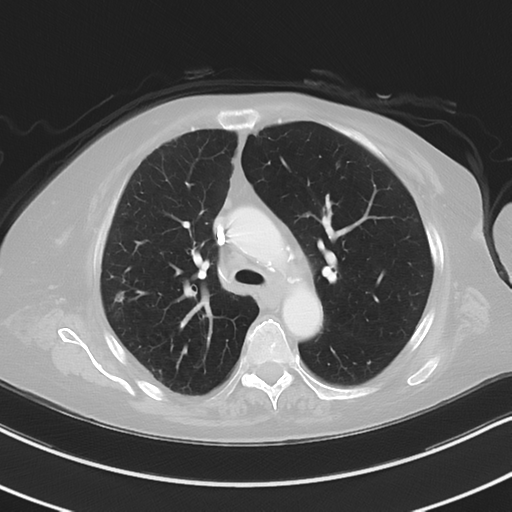 Aspiration bronchiolitis (Radiopaedia 53464-59463 Axial lung window 20).png