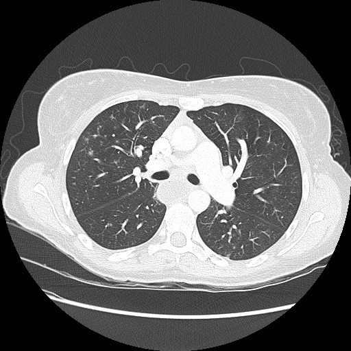File:Aspiration pneumonia secondary to laparoscopic banding (Radiopaedia 18345-18183 lung window 43).jpg