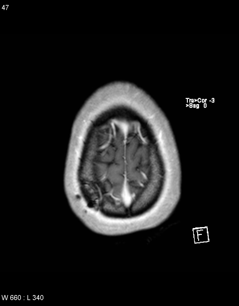 Astroblastoma (Radiopaedia 39792-42218 Axial T1 C+ 46).jpg