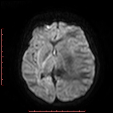 File:Astroblastoma (Radiopaedia 74287-85162 Axial DWI 52).jpg