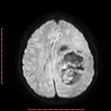 Astroblastoma (Radiopaedia 74287-85162 Axial DWI 70).jpg
