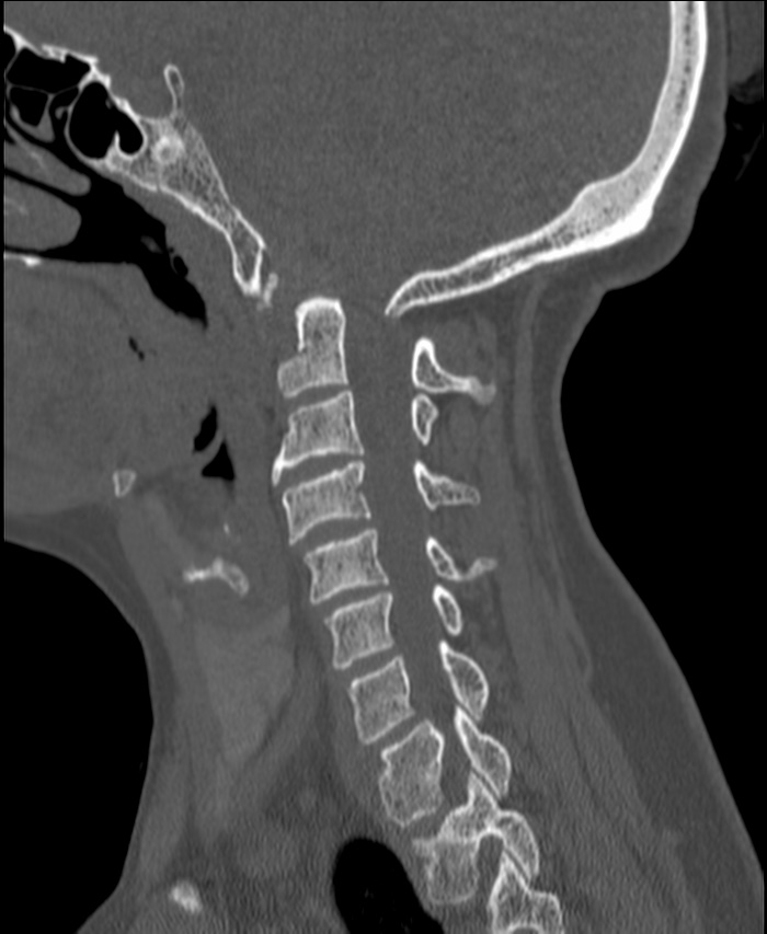 Atlanto-occipital assimilation with basilar invagination (Radiopaedia 70122-80188 Sagittal bone window 40).jpg
