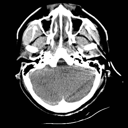 File:Atlanto-occipital dislocation (Radiopaedia 44648-48412 Axial non-contrast 13).jpg
