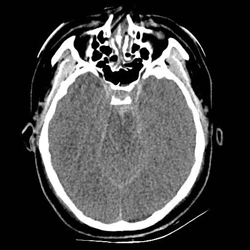 File:Atlanto-occipital dislocation (Radiopaedia 44648-48412 Axial non-contrast 20).jpg