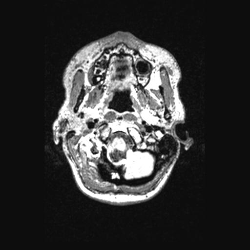 Atretic encephalocoele with inferior vermis hypoplasia (Radiopaedia 30443-31108 Axial 21).jpg