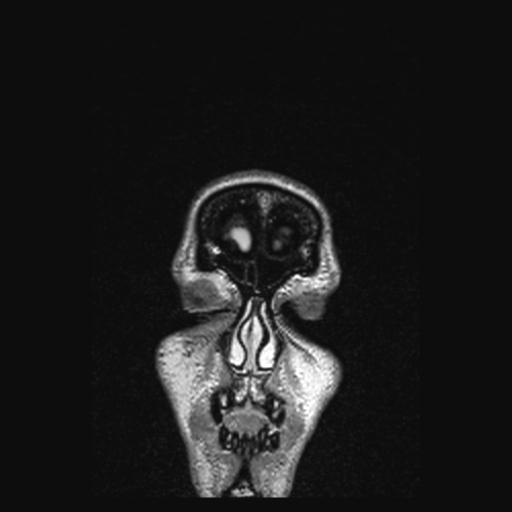 Atretic encephalocoele with inferior vermis hypoplasia (Radiopaedia 30443-31108 Coronal FLAIR 173).jpg