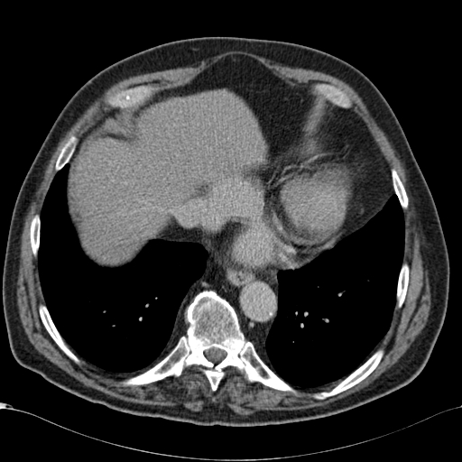 File:Atypical hepatocellular carcinoma (Radiopaedia 41744-44698 Axial C+ delayed 9).jpg