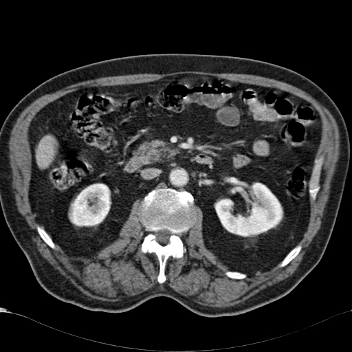 Atypical hepatocellular carcinoma (Radiopaedia 41744-44698 B 46).jpg