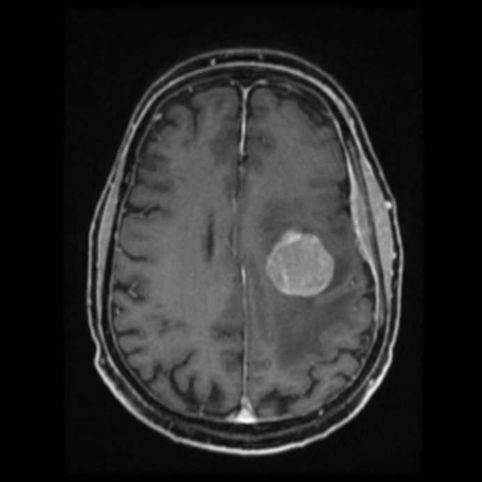 Atypical meningioma (Radiopaedia 45535-49629 Axial T1 C+ 47).jpg