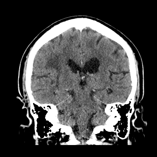 Atypical meningioma (WHO grade II) with brain invasion (Radiopaedia 57767-64728 Coronal C+ 38).png