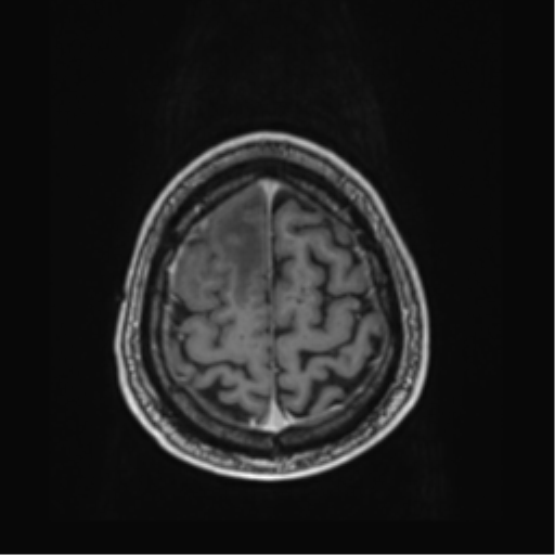 Atypical meningioma (WHO grade II) with brain invasion (Radiopaedia 57767-64729 Axial T1 C+ 43).png