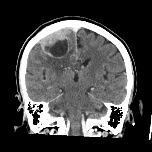 File:Atypical meningioma (WHO grade II) with osseous invasion (Radiopaedia 53654-59715 Coronal C+ delayed 36).png