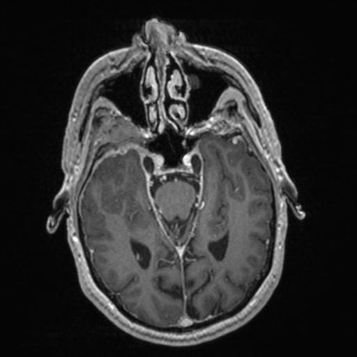 Atypical meningioma (grade II) - en plaque (Radiopaedia 29633-30147 Axial T1 C+ 72).jpg