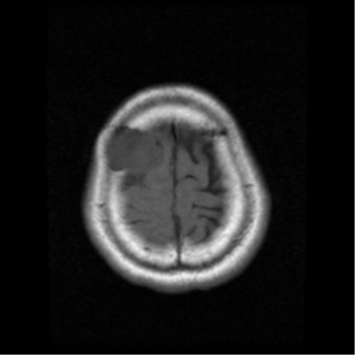 File:Atypical meningioma with skull invasion (Radiopaedia 34357-35648 Axial T1 20).png