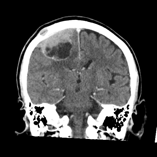 Atypical meningioma with skull invasion (Radiopaedia 34357-35649 Coronal C+ delayed 34).png