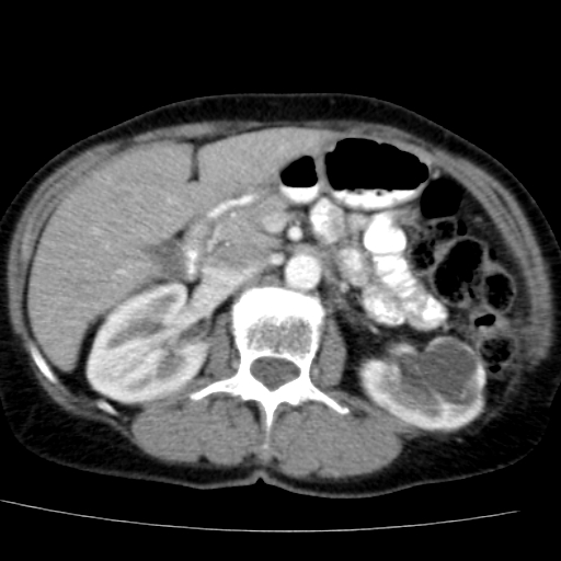File:Atypical renal cyst (Radiopaedia 17536-17251 renal cortical phase 15).jpg