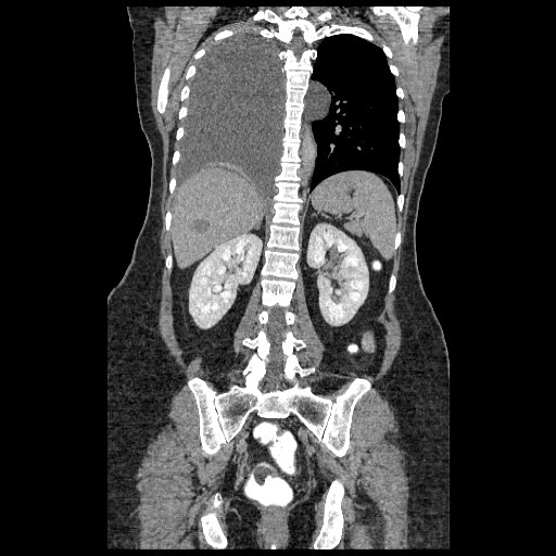 File:Atypical retroperitoneal lymphocoeles with large leiomyoma of uterus (Radiopaedia 32084-33024 B 16).jpg