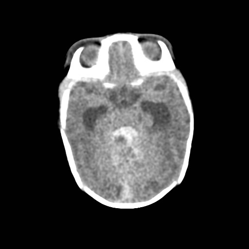 File:Atypical teratoid rhabdoid tumor (prenatal US and neonatal MRI) (Radiopaedia 59091-66387 Axial non-contrast 16).jpg