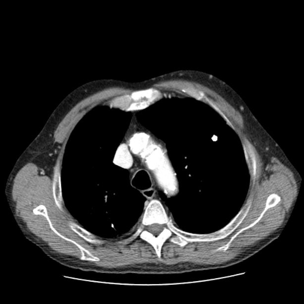 Autosomal dominant polycystic kidney disease (Radiopaedia 27851-28094 B 17).jpg