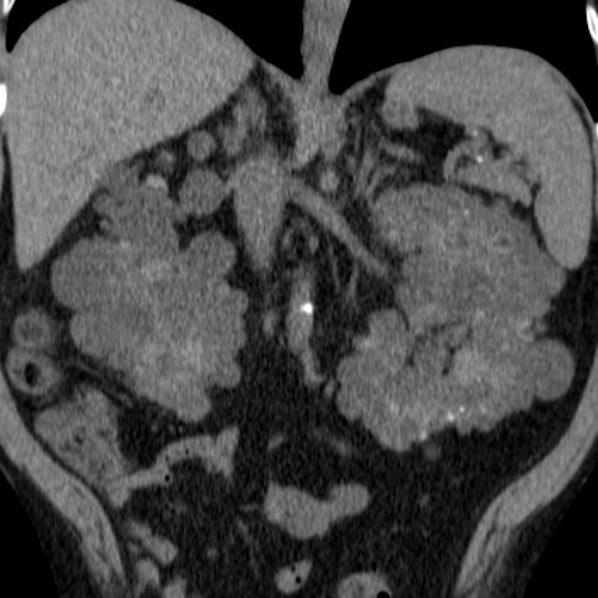 File:Autosomal dominant polycystic kidney disease (Radiopaedia 36539-38101 Coronal non-contrast 22).jpg