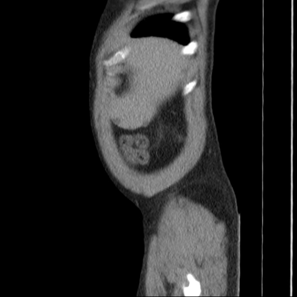 Autosomal dominant polycystic kidney disease (Radiopaedia 36539-38101 D 9).jpg