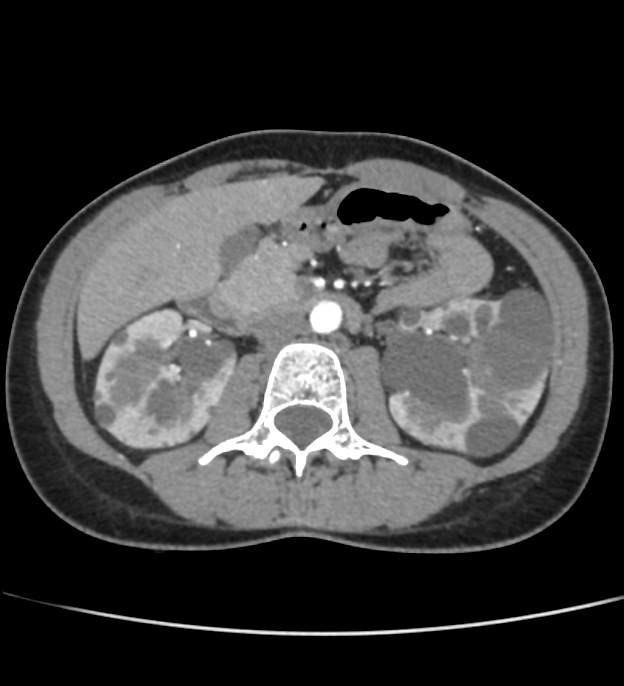 Autosomal dominant polycystic kidney disease - early onset (Radiopaedia 40734-43387 B 27).jpg