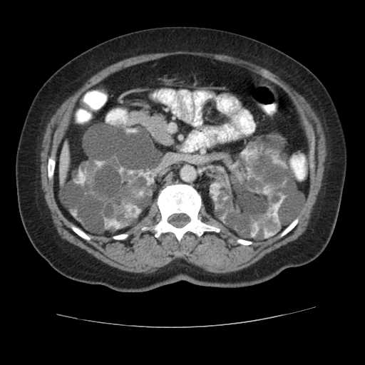 Autosomal dominant polycystic kidney disease with hepatic involvement (Radiopaedia 32693-33662 B 31).jpg