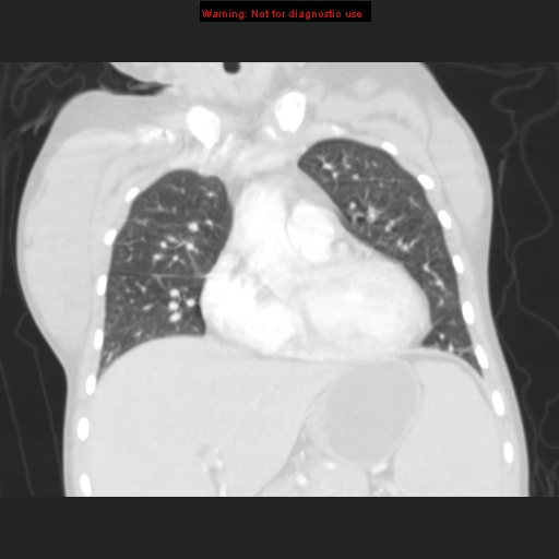 File:Avascular necrosis in sickle cell disease (Radiopaedia 17448-17152 B 45).jpg