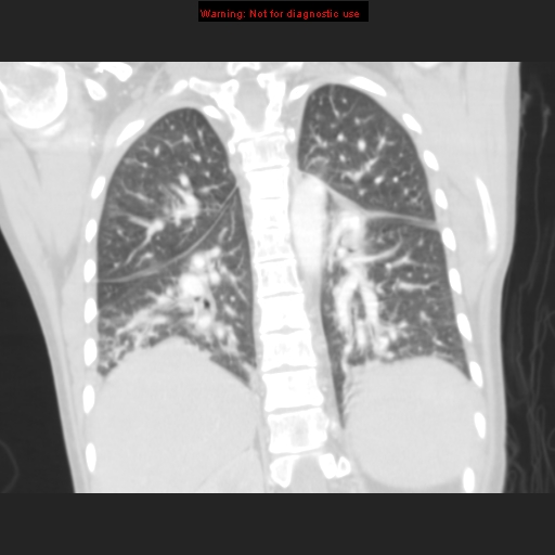 File:Avascular necrosis in sickle cell disease (Radiopaedia 17448-17152 B 88).jpg