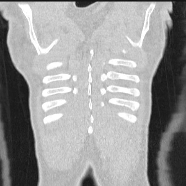 Azygos lobe (Radiopaedia 38259-40275 Coronal lung window 73).jpg