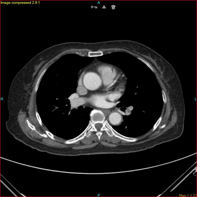 Azygos vein aneurysm (Radiopaedia 77824-90130 B 31).jpg