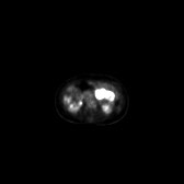 B-cell lymphoma of the mesentery (Radiopaedia 65743-74868 18F-FDG PET-CT 141).jpg