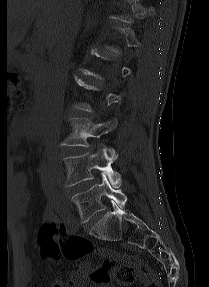 File:Baastrup syndrome (Radiopaedia 64891-73838 Sagittal bone window 3).jpg