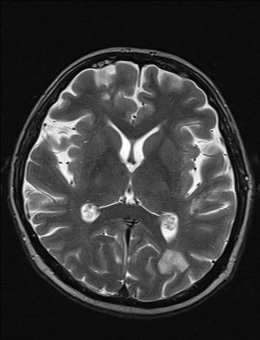 File:Balo concentric sclerosis (Radiopaedia 50458-55940 Axial T2 22).jpg