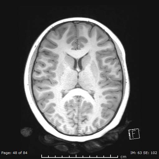 Balo concentric sclerosis (Radiopaedia 61637-69636 Axial T1 48).jpg