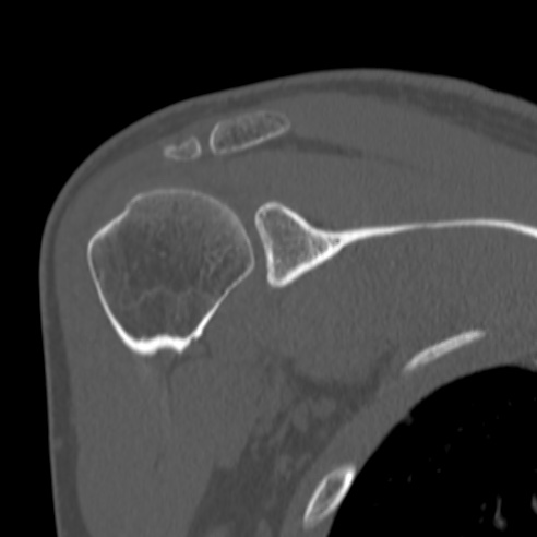 Bankart lesion (Radiopaedia 57256-64185 Coronal bone window 22).jpg
