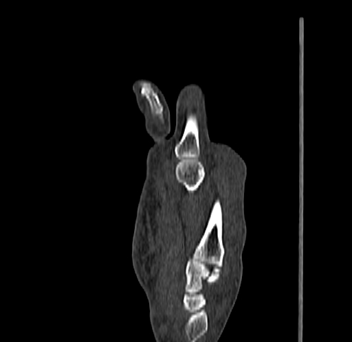 Base of 2nd metacarpal fracture (Radiopaedia 73741-84544 Sagittal bone window 47).jpg