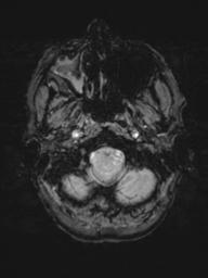 Base of skull chondrosarcoma (Radiopaedia 30410-31070 Axial SWI 6).jpg