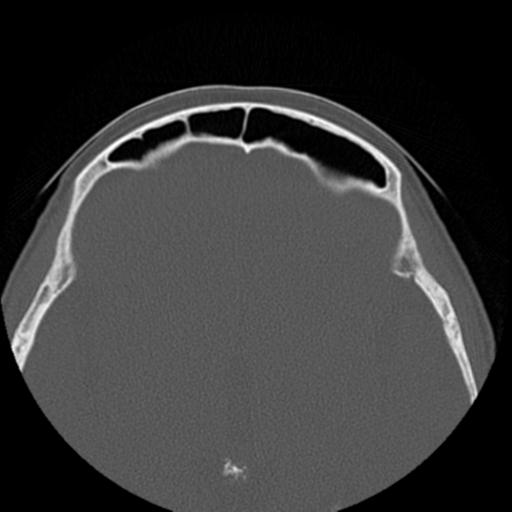 File:Base of skull chondrosarcoma (Radiopaedia 30410-31071 Axial bone window 38).jpg